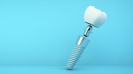 Dental Implant Best Solution For A Missing Tooth