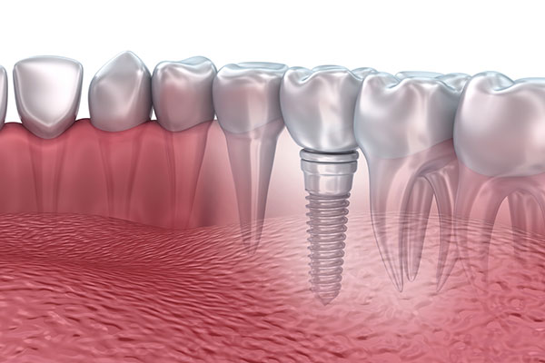 best dental implants